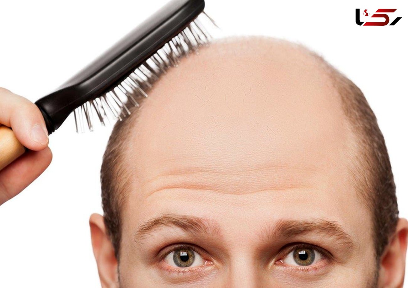  درمان ریزش مو با نسخه ای طلایی