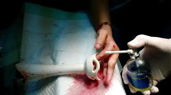 گیر کردن دست زن خانه دار در گوشت کوب برقی + عکس