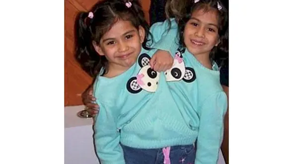 تغییر بزرگ در زندگی دو قلوهای به هم چسبیده +تصویر