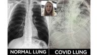 A Doctor shares shocking image of Covid-19 patient's lung 'worse than any smokers'
