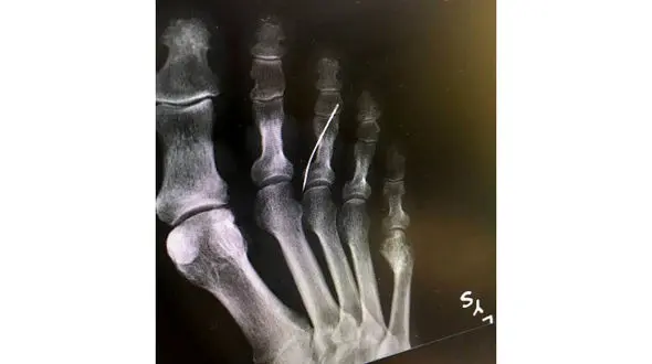 دردسر سوزن خیاطی برای پیرزن بی خبر از همه جا+ عکس