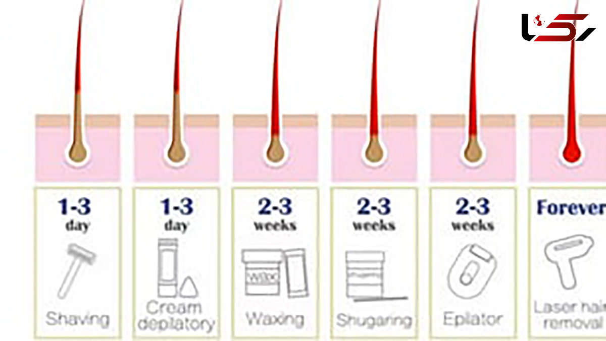 راه های از بین بردن دائمی موهای زائد در منزل