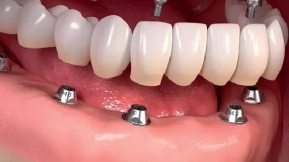 در خصوص ایمپلنت و کامپوزیت بیشتر بدانیم