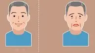 میاستنی گراویس چیست؟ / این افتادگی چشم را جدی بگیرید + فیلم