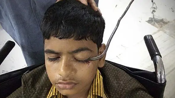 خروج قلاب از چشم و مغز پسر بازیگوش + عکس