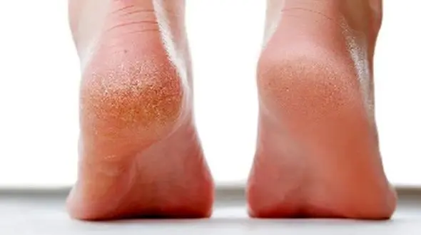 نشانه‌ های کمبود ویتامین در پاها؛ اینفوگرافیک راهنما