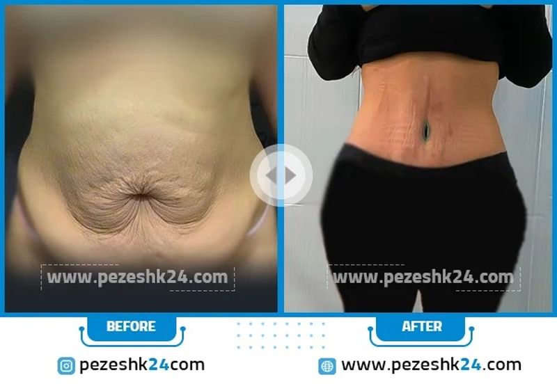 عکس قبل و بعد تخلیه شکم
