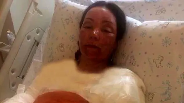 سوختگی دردناک معلم کودکان بی سرپرست +عکس