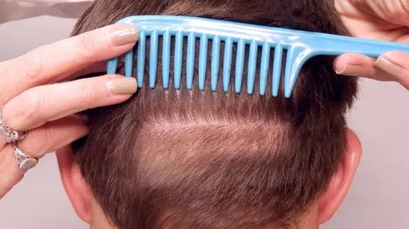 چرا برخی افراد نمی توانند کاشت مو انجام دهند؟