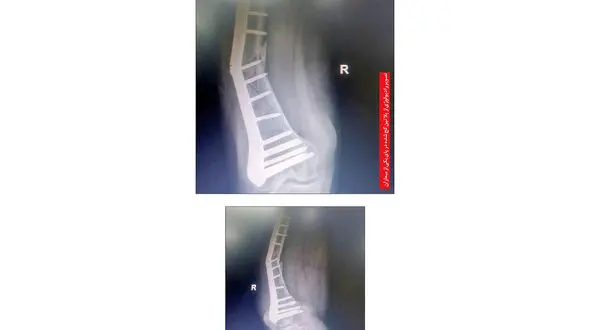 جنجال پلاتین های کج شده در بدن بیماران بیمارستانی در نیشابور / پشت پرده شرکت تولید پلاتین چیست؟ + عکس