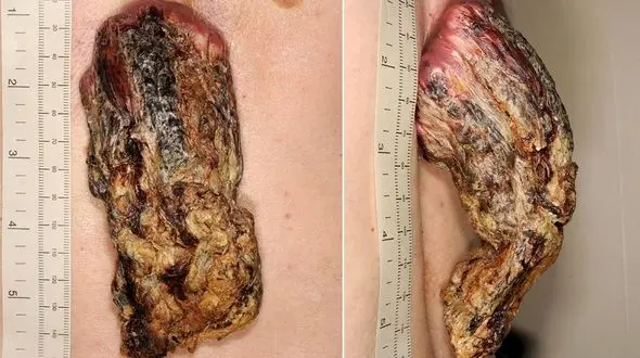 شاخ سرطانی مردی بالاخره پس از ۳ سال از بدنش جدا شد+ تصاویر
