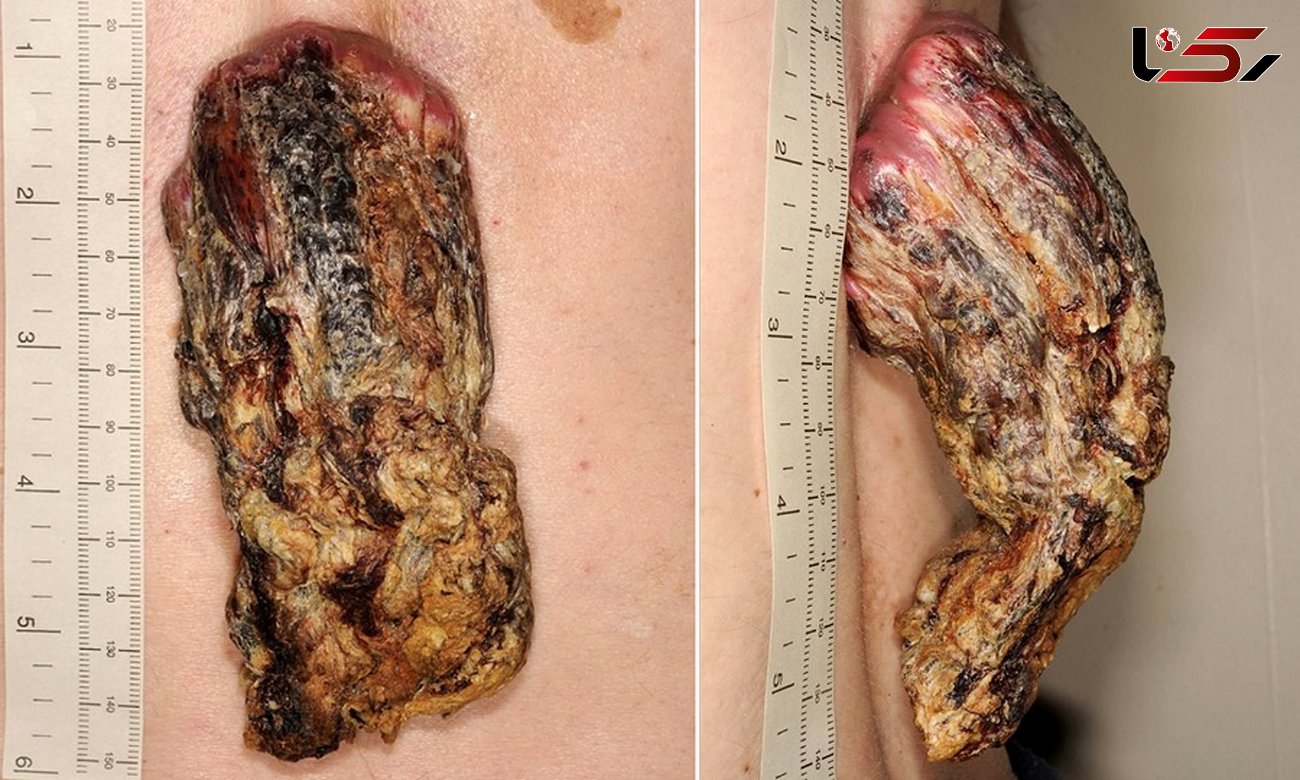 شاخ سرطانی مردی بالاخره پس از ۳ سال از بدنش جدا شد+ تصاویر
