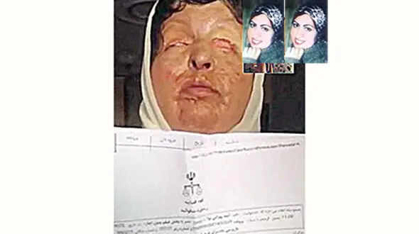 شکایت آمنه بهرامی از «لانتوری» / بار دیگر سوختم + عکس