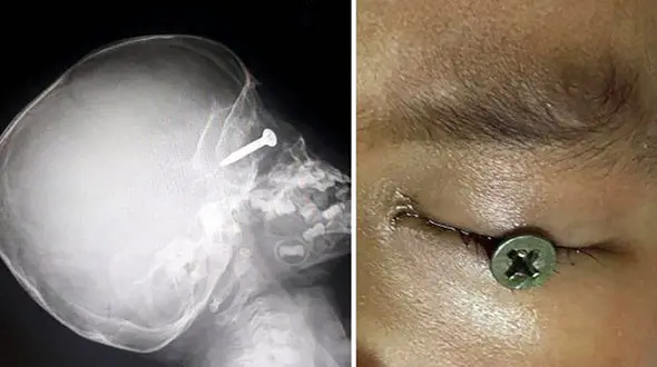 عکس عجیب از فرو رفتن یک پیچ به داخل چشم پسر 3 ساله