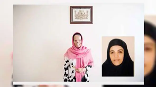 عروس کینه جو نیمه شب روی صورت خواهرشوهرش اسید ریخت + عکس های تکاندهنده