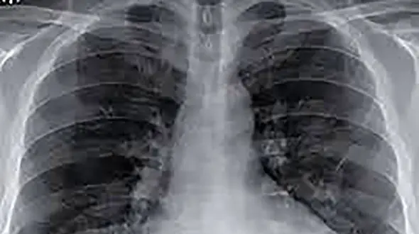 از کجا بفهمیم ریه های مان درگیر کرونا شده؟