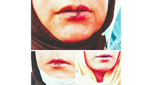 11 زنان معترض دهانشان را دوختند / اعتراض این زنان افغان به چیست؟+ عکس لبان دوخته شده
