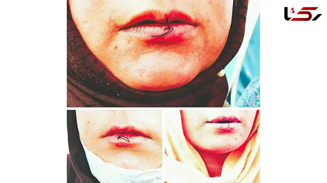 11 زنان معترض دهانشان را دوختند / اعتراض این زنان افغان به چیست؟+ عکس لبان دوخته شده
