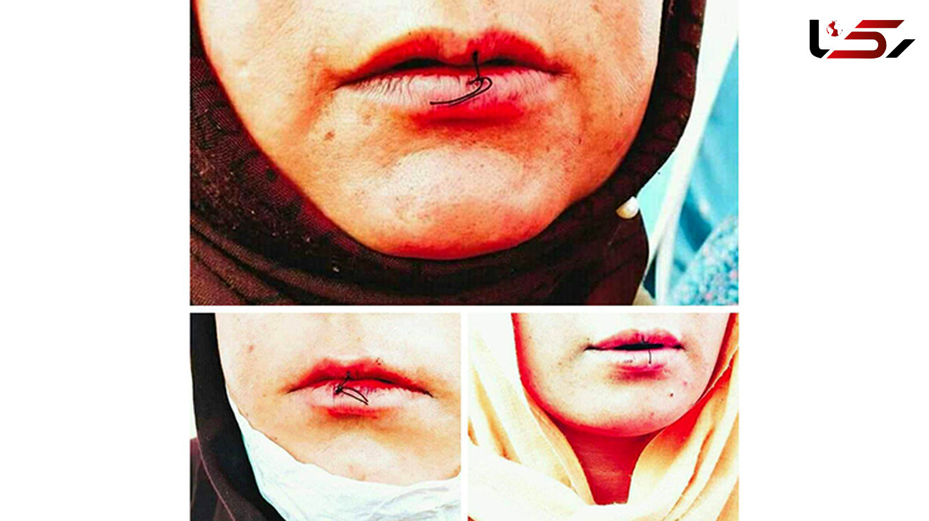 11 زنان معترض دهانشان را دوختند / اعتراض این زنان افغان به چیست؟+ عکس لبان دوخته شده