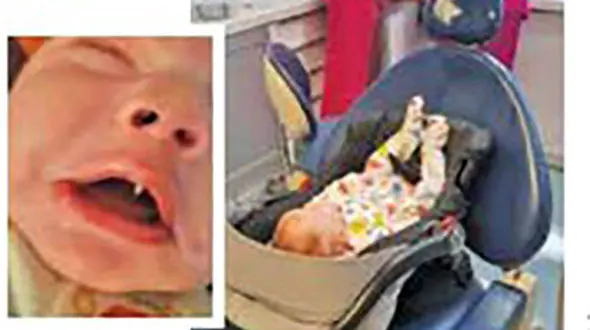 نوزادی با دندان خون آشام‌ها