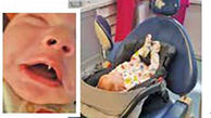 نوزادی با دندان خون آشام‌ها