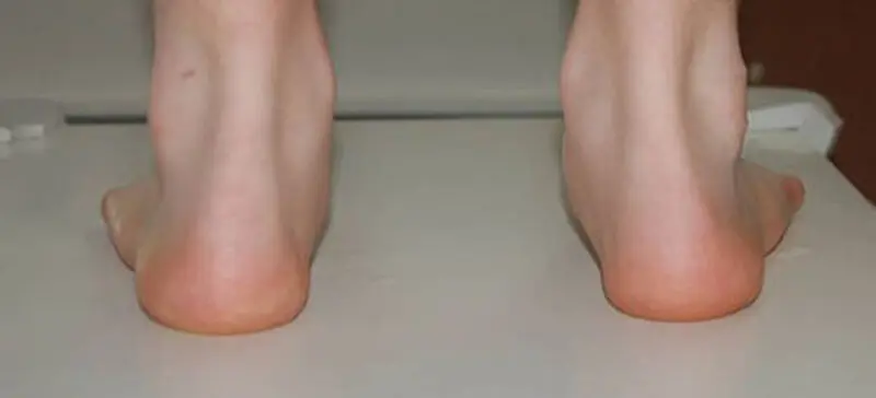 مفصل آشیل
