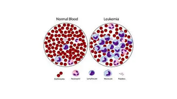 نشانه های لوسمی مزمن لنفوسیتی 