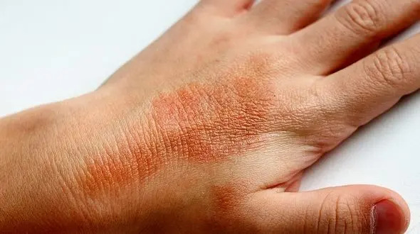 آب سخت یکی از عوامل بروز اگزمای پوستی