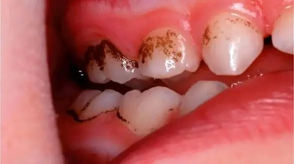 بهترین خوراکی‌ ها برای حفظ سلامت دندان‌ های شما