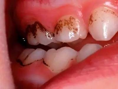 بهترین خوراکی‌ ها برای حفظ سلامت دندان‌ های شما