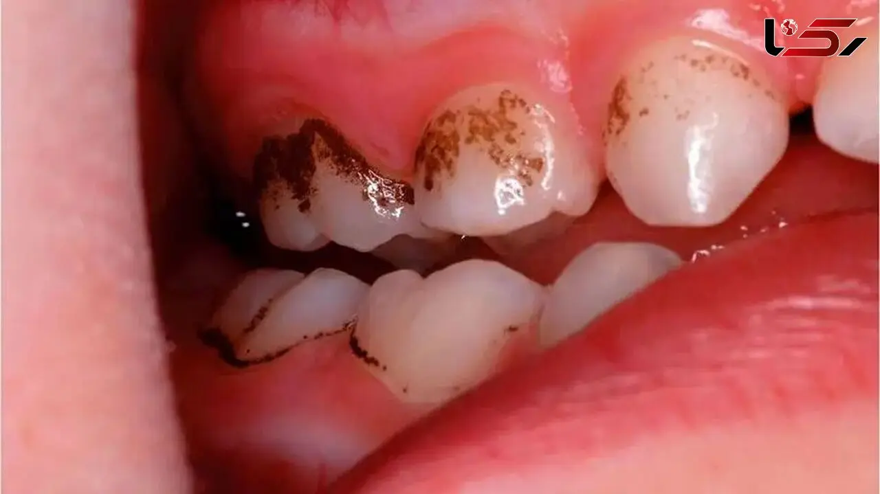 بهترین خوراکی‌ ها برای حفظ سلامت دندان‌ های شما
