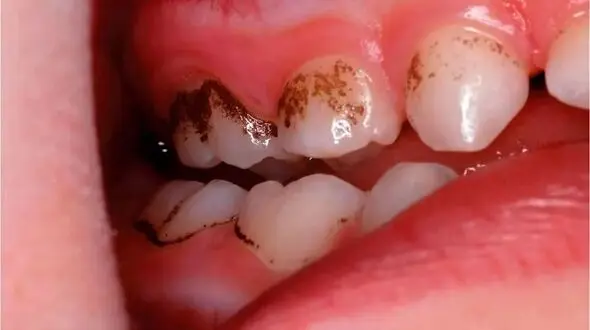 بهترین خوراکی‌ ها برای حفظ سلامت دندان‌ های شما
