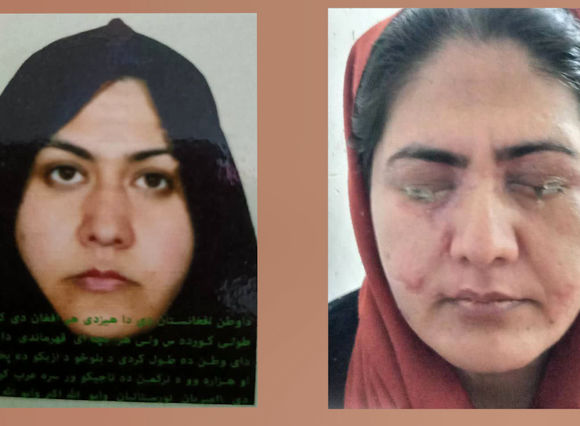 برادر در چشمان خواهر اسید ریخت تا سر کار نرود!/ این زن به کمک ما نیاز دارد + فیلم