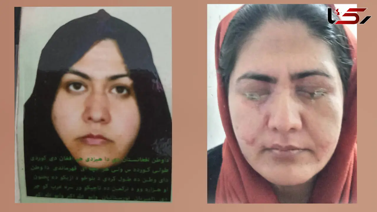 برادر در چشمان خواهر اسید ریخت تا سر کار نرود!/ این زن به کمک ما نیاز دارد + فیلم