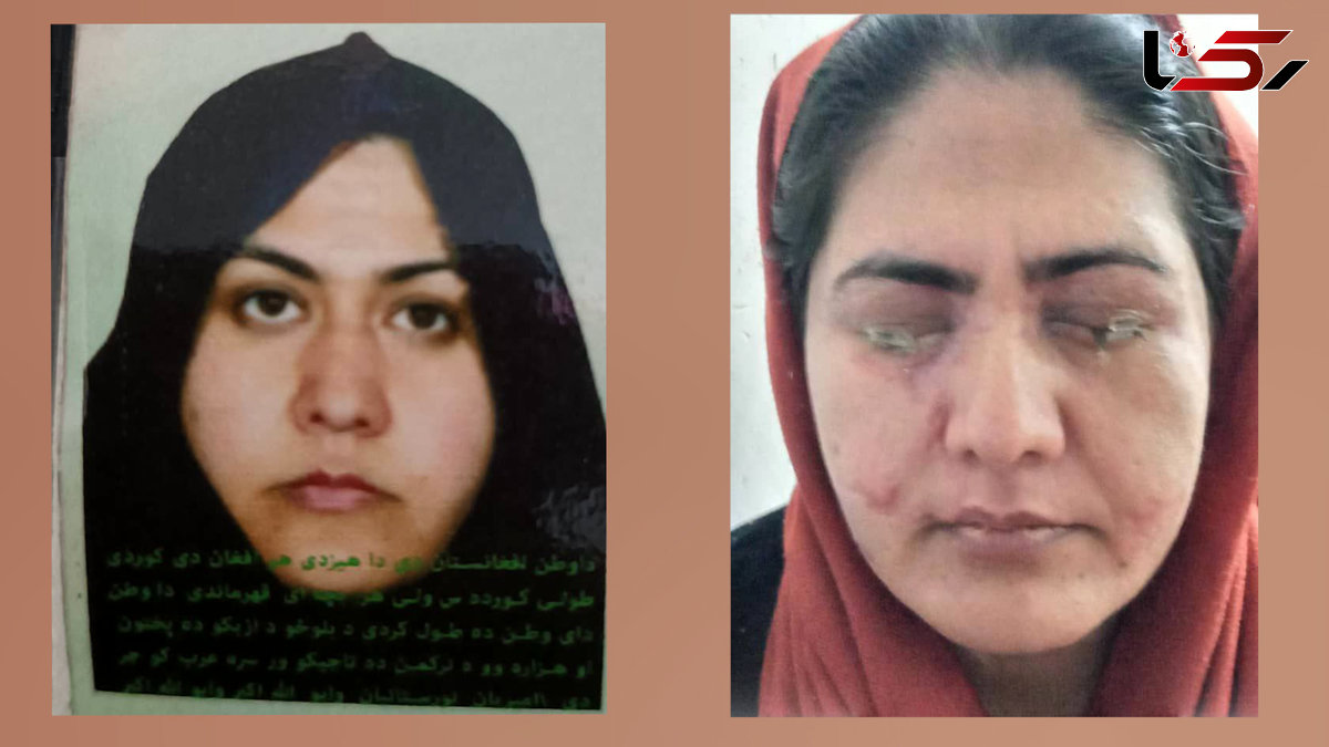 برادر در چشمان خواهر اسید ریخت تا سر کار نرود!/ این زن به کمک ما نیاز دارد + فیلم