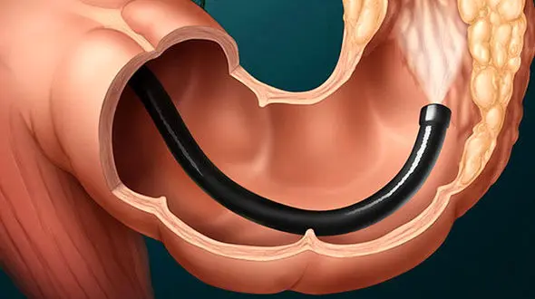 نحوه تشخیص سرطان روده