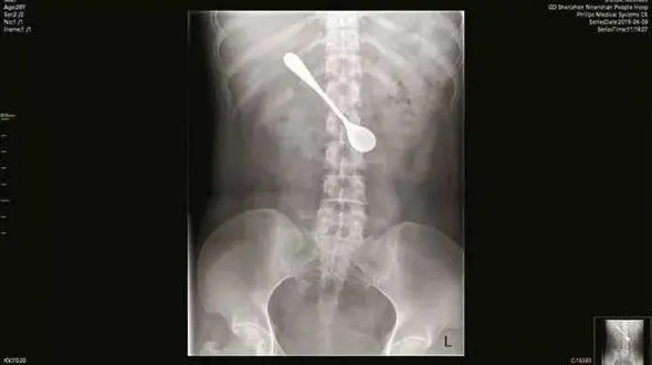 زن جوان قاشق 13 سانتی را قورت داد / در چین اتفاق افتاد + عکس