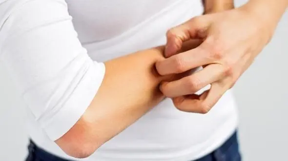 درمان بیماری پسوریازیس با نسخه طب سنتی