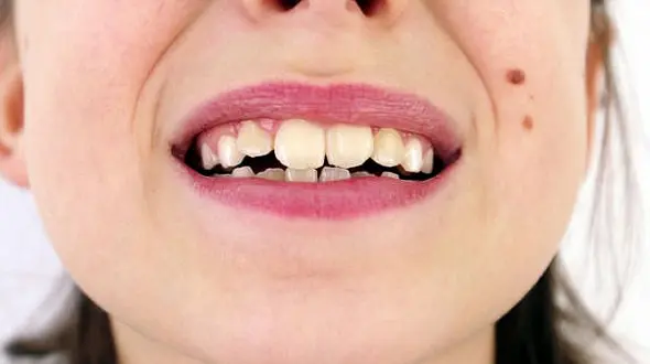 اگر دندان نیش تان کج است، بخوانید