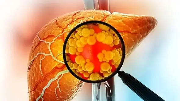 راه‌های ساده و موثر برای پیشگیری از کبد چرب