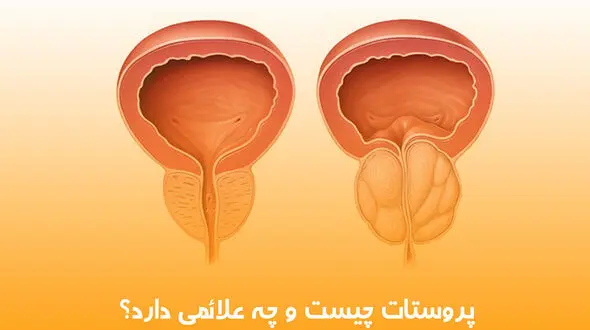 علائم بیماری پروستات چیست؟ / جدول مقایسه پروستات خوش‌ خیم و بدخیم