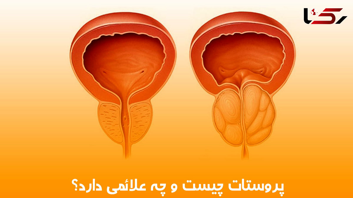 علائم بیماری پروستات چیست؟ / جدول مقایسه پروستات خوش‌ خیم و بدخیم