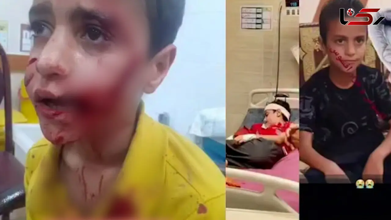 حمله خونین سگ ولگرد به پسر 11 ساله در مسجدسلمیان