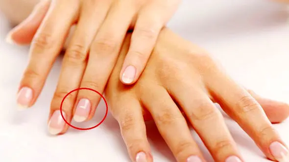 علت لکه‌های سفید روی ناخن +فیلم