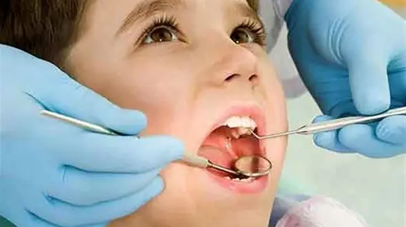 آیا استفاده از قطره آهن موجب پوسیدگی دندان کودکان می شود؟