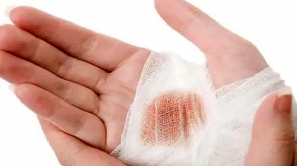 5 باور غلط در درمان سوختگی 