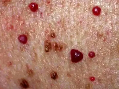 خال قرمز روی پوست: علل، نشانه‌ ها و روش‌ های درمان