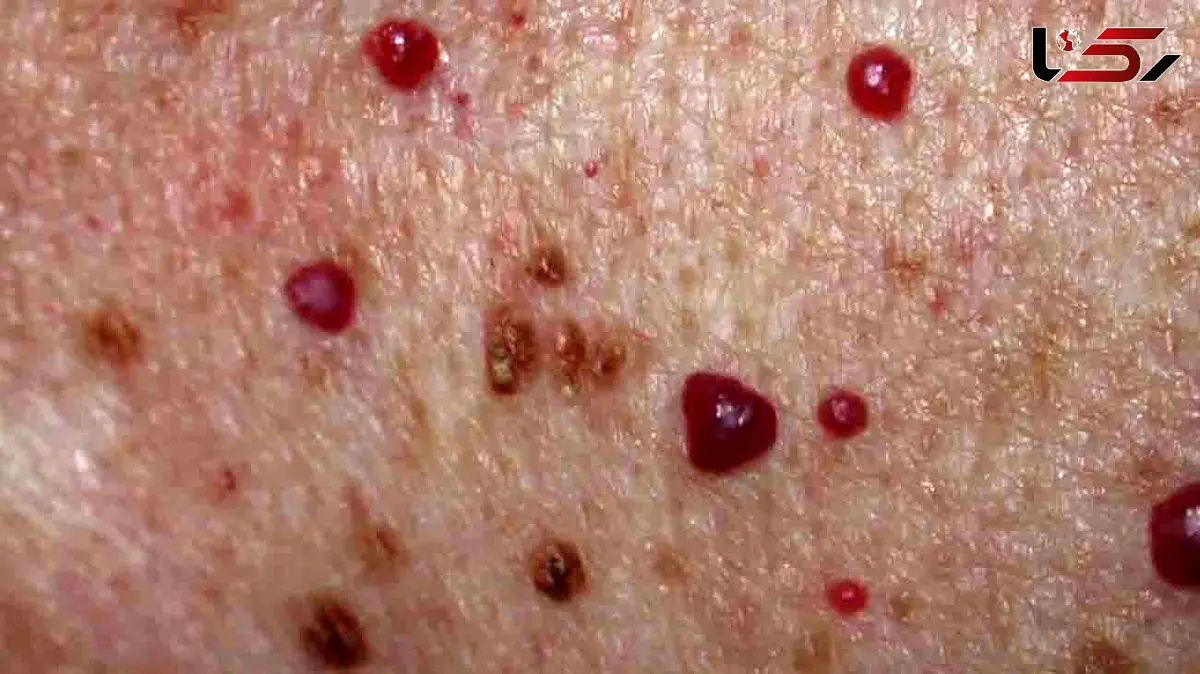 خال قرمز روی پوست: علل، نشانه ها و روش های درمان