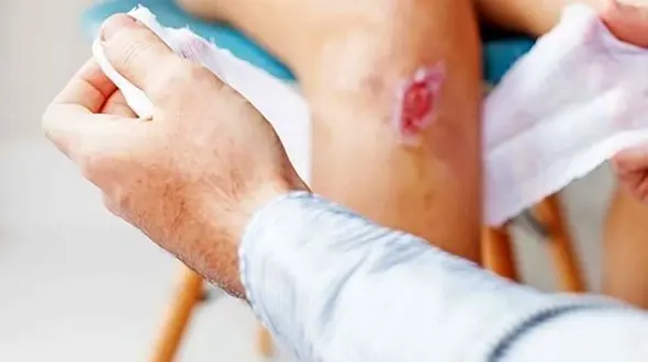 مهم ترین نشانه های عفونت زخمی