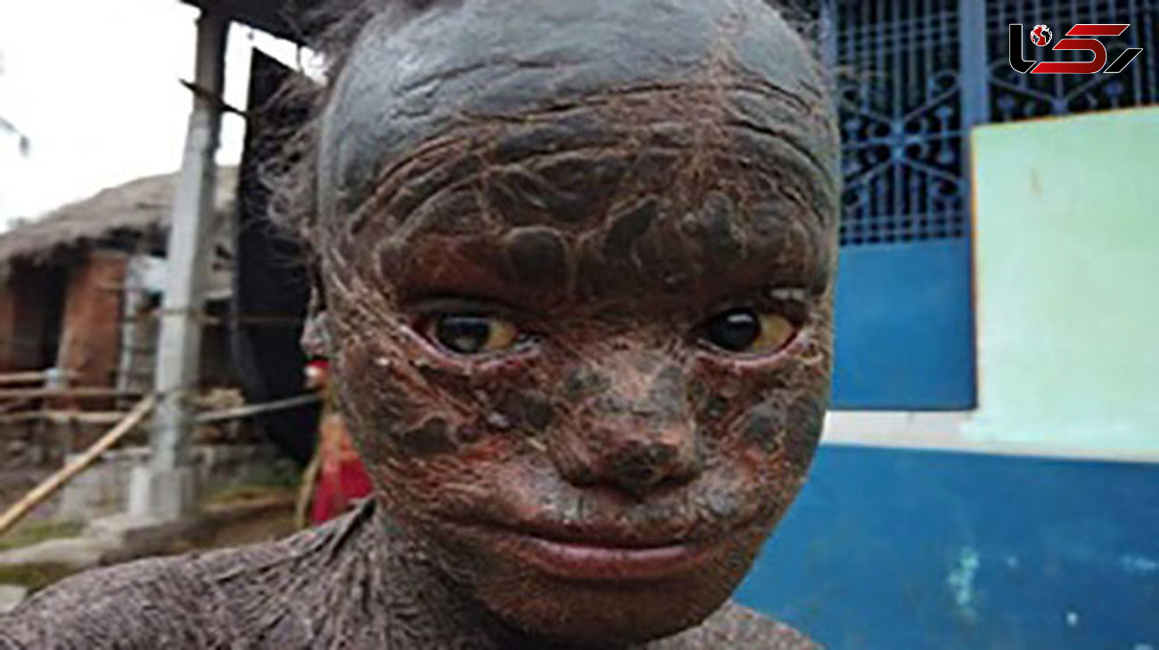 سرنوشت هولناک پسر 10 ساله ای که پوست او را باید کند !+عکس